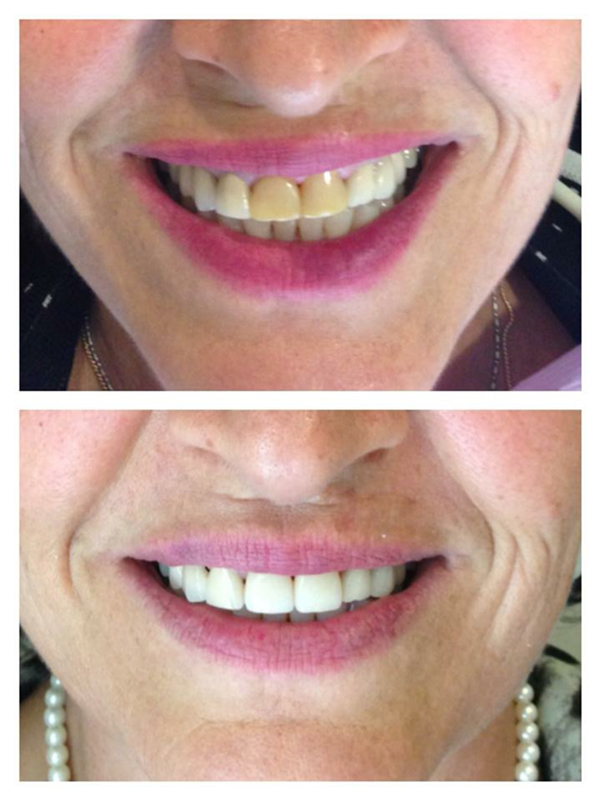 Linh Bauer, DDS - Smile Gallery | Linh Bauer, DDS | Improve Your Smile